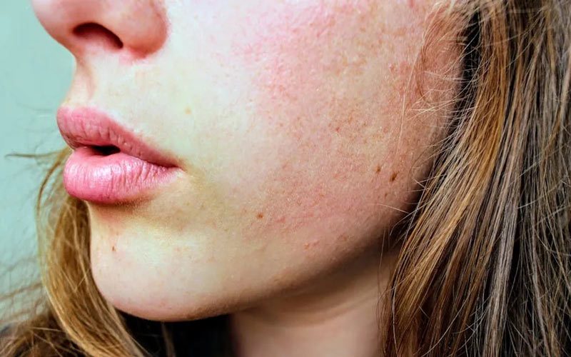 How to effectively alleviate winter skin accelerated aging?
